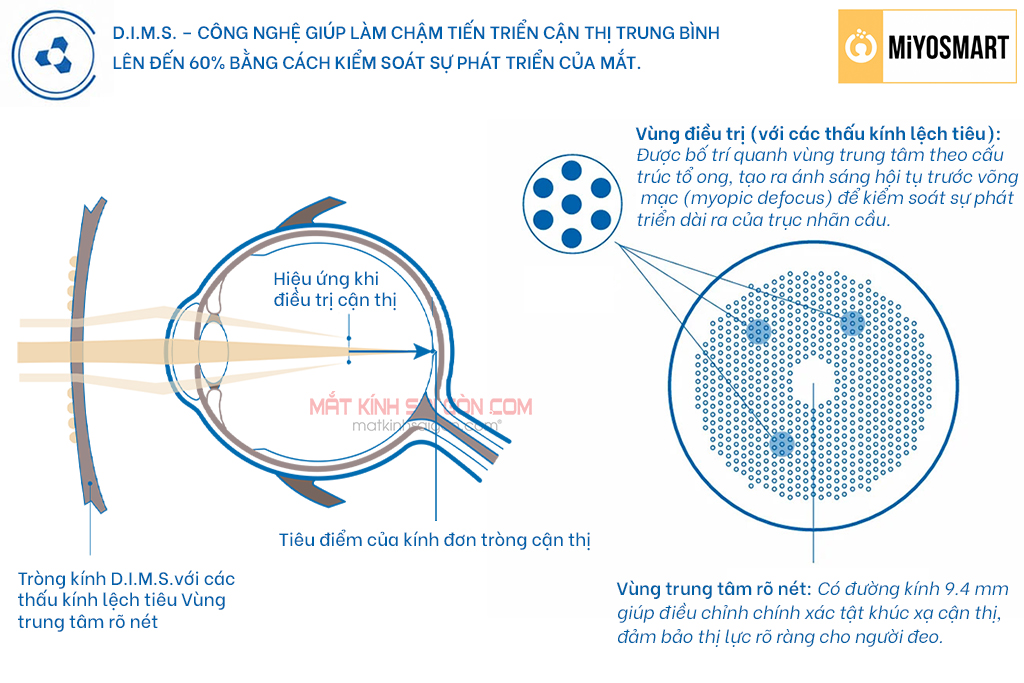 TRÒNG KÍNH KIỂM SOÁT CẬN THỊ HOYA MiYOSMART 1.59 - Hình 3