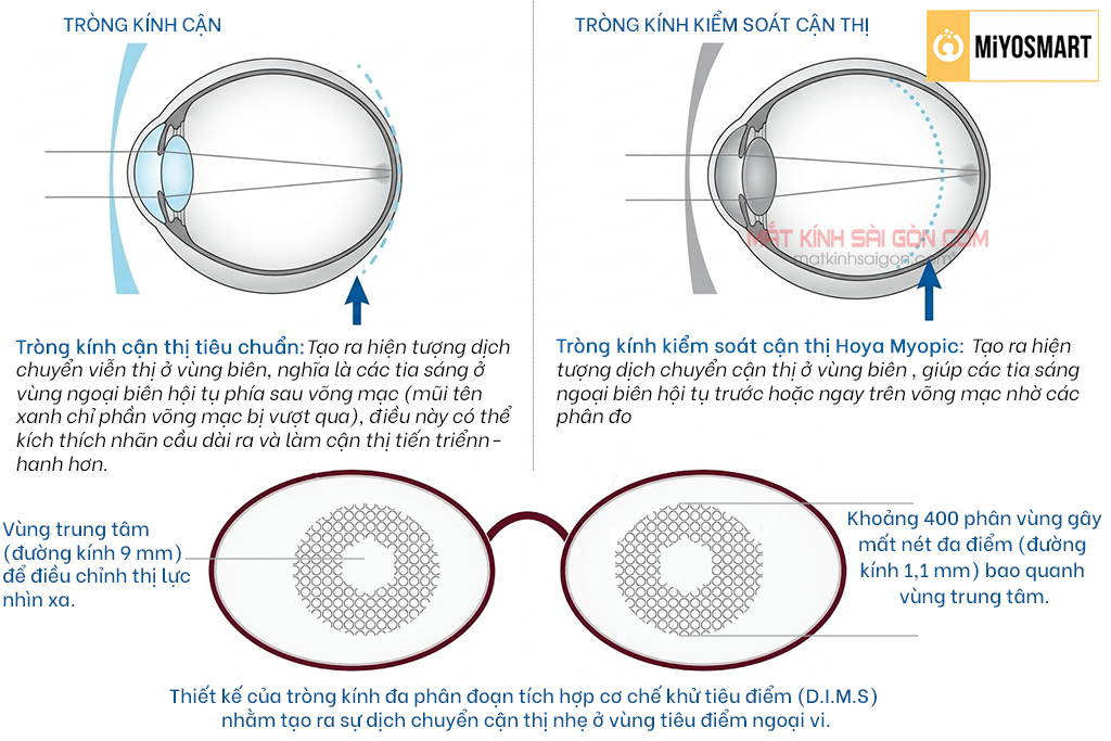 TRÒNG KÍNH KIỂM SOÁT CẬN THỊ HOYA MiYOSMART 1.59 - Hình 4